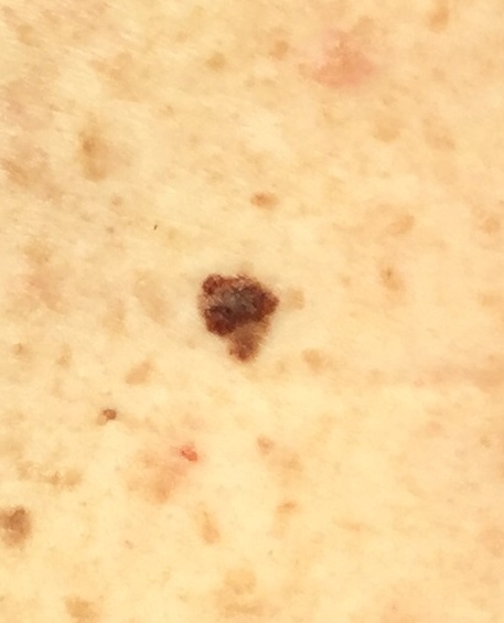 Malignant Melanoma Clear Dermatology Malignant Melanoma Clear Dermatology