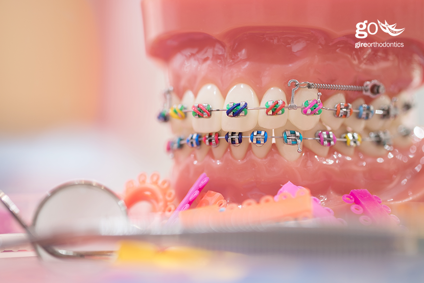 Orthodontist That Take Insurance Near Me Gire Orthodontics Orthodontist That Take Insurance Near Me Gire Orthodontics