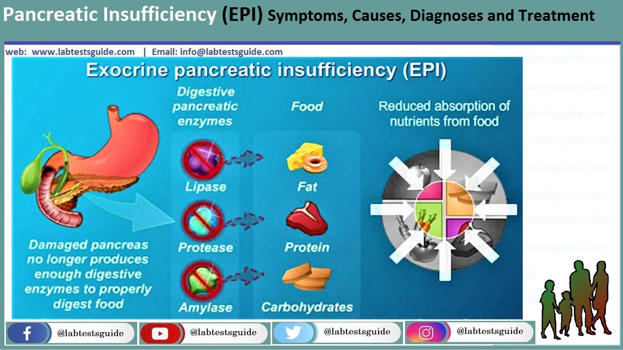 Pancreas Deficiency Pancreatic Insufficiency A Comprehensive Guide Pancreas Deficiency Pancreatic Insufficiency A Comprehensive Guide