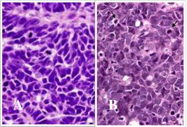 Small Cell Cancer Vs Large Cell Cancer